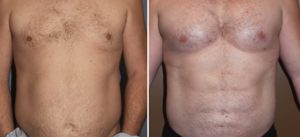 pectoral-implants-and-abdominal-etching-result-front-view-dr-barry-eppley-indianapolis