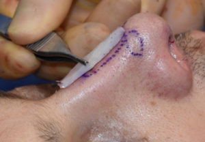 rib-graft-rhinoplasty-intraop-dr-barry-eppley-indianapolis
