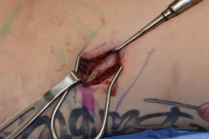 rib-removal-12-angulation-dr-barry-eppley-indianapolis