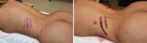 rib-removal-for-waistline-narrowijng-intraop-left-side