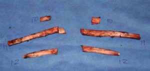 rib-removal-for-wasitline-narrowing-specimens-dr-barry-eppley-indianapolis