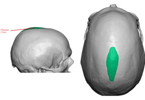 sagittal-ridge-reduction-3d-ct-planning-dr-barry-eppley-indianapolis