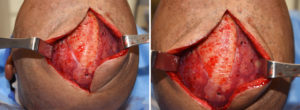 skull-implant-and-sagittal-reduction-intraop-dr-barry-eppley-indianapolios