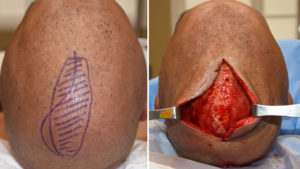 skull-reduction-and-implant-surgical-plan-and-incision-dr-barry-eppley-indianapolis
