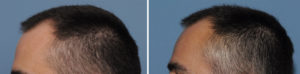 small-skull-implant-augmentation-results-side-view-ddr-barry-eppley-indianapolis