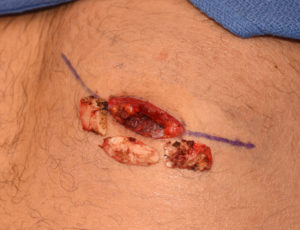 subcostal-rib-shave-dr-barry-eppley-indianapolis