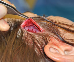subfascial-temporal-implant-intraop-dr-barry-eppley-indianapolis