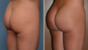 tb-buttock-implants-oblique-view-dr-barry-eppley-indianapolis
