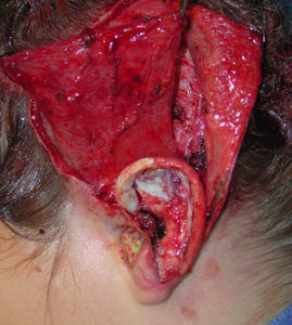 temporoparietal-flap-in-ear-reconstruction-dr-barry-eppley-indianapolis