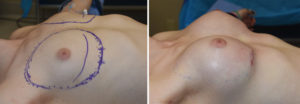transgender-breast-augmentation-intraop-result-right-side-dr-barry-eppley-indianapolis