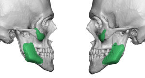 wrong-cheek-and-jaw-angle-implants-2-dr-barry-eppley-indianapolis