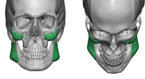 wrong-cheek-and-jaw-angle-implants-dr-barry-eppley-indianapolis