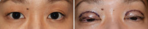 asian-double-eyelid-surgery-intraop-dr-barry-eppley-indianapolis