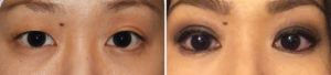 asian-double-eyelid-surgery-results-front-view-dr-barry-eppley-indianapolis