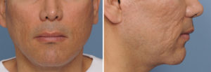 Before Custom Jawline Implant Dr Barry Eppley Indianapolis