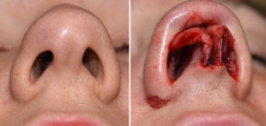 bifid-tip-rhinoplasty-dr-barry-eppley-indianapolis