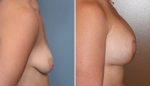 Breast Implant and Lift Surgery result side view Dr Barry Eppley Indianapolis