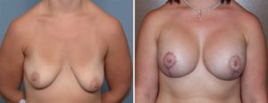 Breast Implant and Lift surgery result front view Dr Barry Eppley Indianapolis
