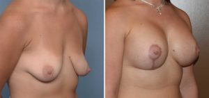 Breast Implant and Lift surgery result oblique view Dr Barry Eppley Indianapolis