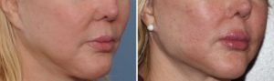 cw-jaw-angle-implants