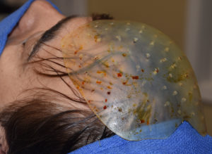 Custom Forehead Implant Dr Barry Eppley Indianapolis