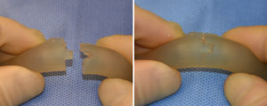 Custom Jawline Implant Re-assembly Dr Barry Eppley Indianapolis