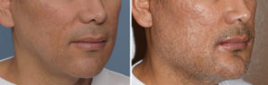 Custom Jawline Implant Replacement of Medpor Implants result oblique view Dr Barry Eppley Indianapolis