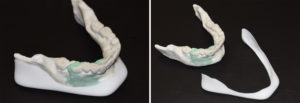 Custom Jawline Implant design on model Dr Batrry Eppley Indianapolis