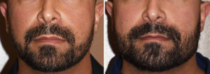 Custom Jawline Implant result front view Dr Barry Eppley Indianapolis