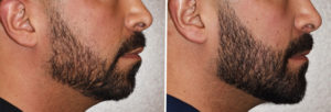 Custom Jawline Implant result side view Dr Barry Eppley Indianapolis