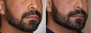 Custom Jawline Implant results oblioque view Dr Barry Eppley Indianapolis