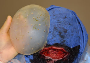 custom-skull-implant-ready-for-placement-dr-barry-eppley-indianapolis