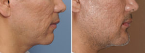 Cusytom Jawline Implant Replacement for Medpor Implants result side view Dr Barry Eppley Indianapolis