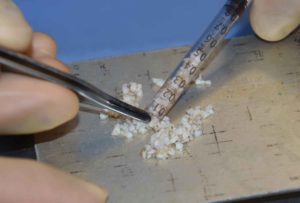 diced-cartilage-graft-rhinoplasty-preparation-dr-barry-eppley-indianapolis