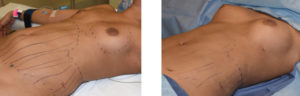 Fat Injection Breast Augmentation Dr Barry Eppley Indianapolis