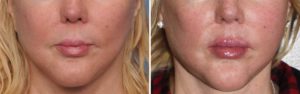 female-jaw-angle-implants-result-front-view-dr-barry-eppley-indianapolis