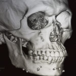 Medpor Chin and Jaw Angle Implant Jawline Augmentation Dr Barry Eppley Indianapolis