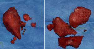 Medpor Jaw Implant Removals Dr Barry Eppley Indianapolis