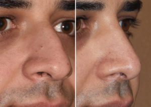 middle-eastern-male-rhinoplasty-results-oblique-view-dr-barry-eppley-indianapolis