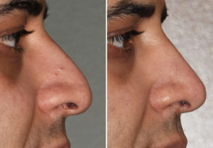 middle-eastern-male-rhinoplasty-resulys-side-view