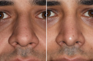 middle-eastern-male-rhinoplasty-result-front-view-dr-barry-eppley-indianapolis