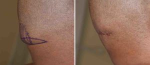 Occipital Knob and Roll Reduction result Dr Barry Eppley Indianapolis
