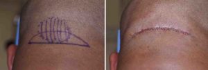 Occipital Knob and Roll reduction intraop Dr Barry Eppley Indianapolis