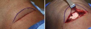 Occipital Knob reduction intraop