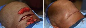 Occipital Roll Reduction intraop DR Barry Eppley Indianapolis