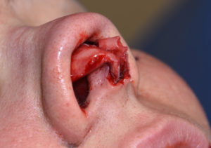 open-rhinoplasty-indianapolis-dr-barry-eppley