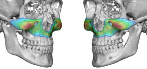 total-custom-midface-implant-dr-barry-eppley-indianapolis