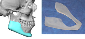 male custom jawline implant design and actual implant Dr Barry Eppley Indianapolis