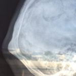 occipital knob deformity