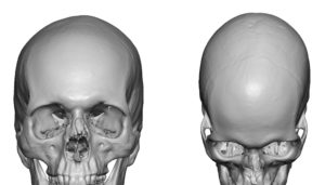 3D Forehead Deficiency Dr Barry Eppley Indianapolis